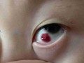 吃瓜吃豆眼早上肿,揭秘早晨眼部肿胀之谜