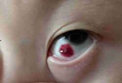 吃瓜吃豆眼早上肿,揭秘早晨眼部肿胀之谜