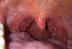 吃瓜过敏喉咙难受,揭秘过敏源及应对策略