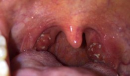 吃瓜过敏喉咙难受,揭秘过敏源及应对策略